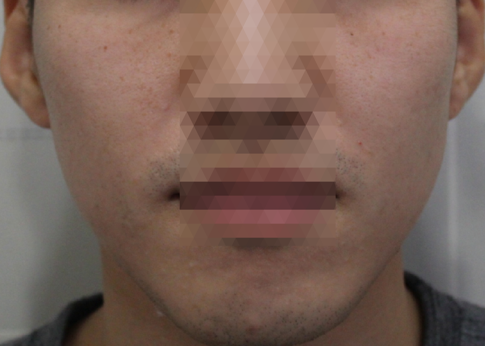 전주여드름한의원 치료 후 정면 모습