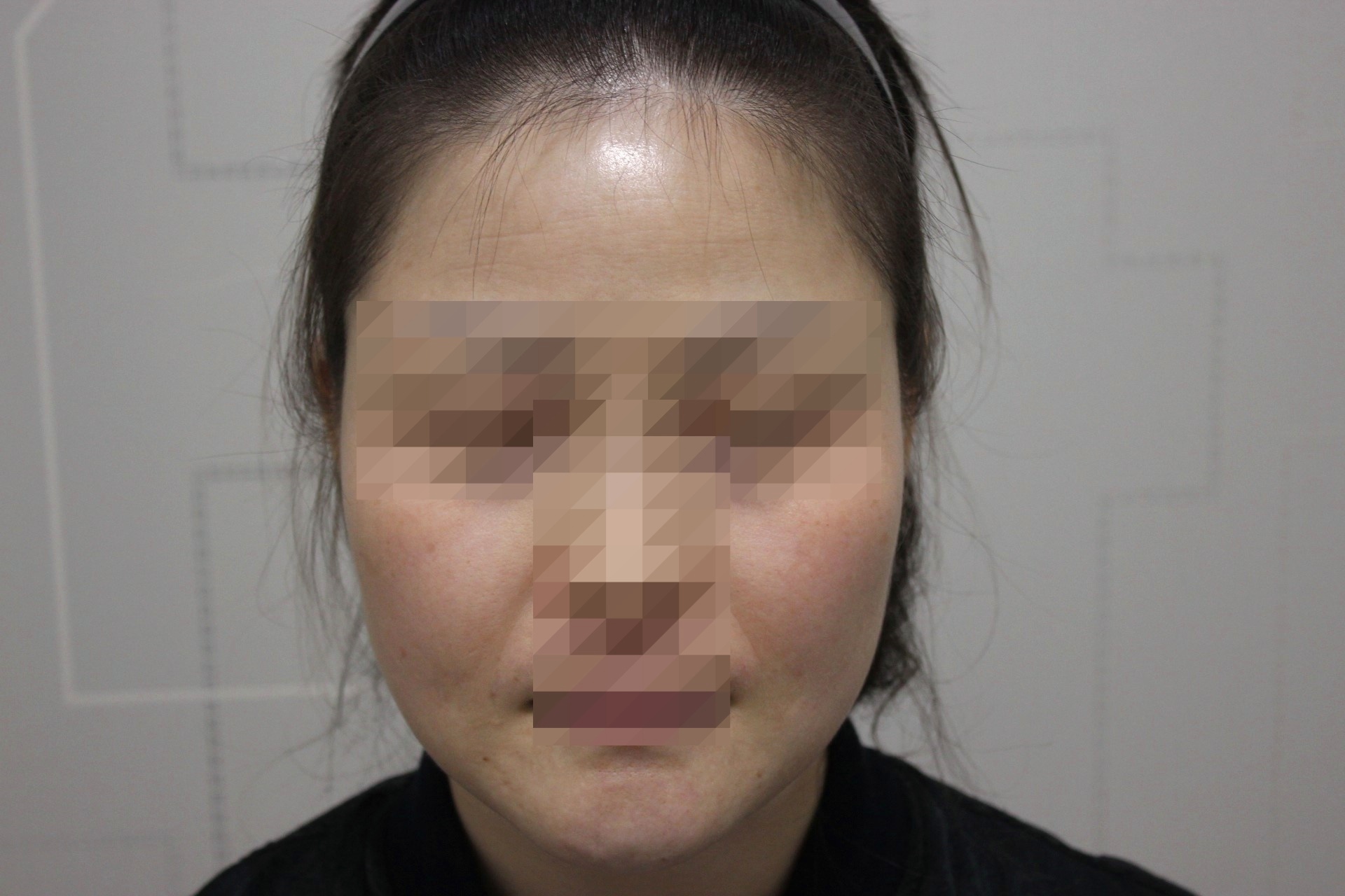 전주지루성피부염 치료 후 정면
