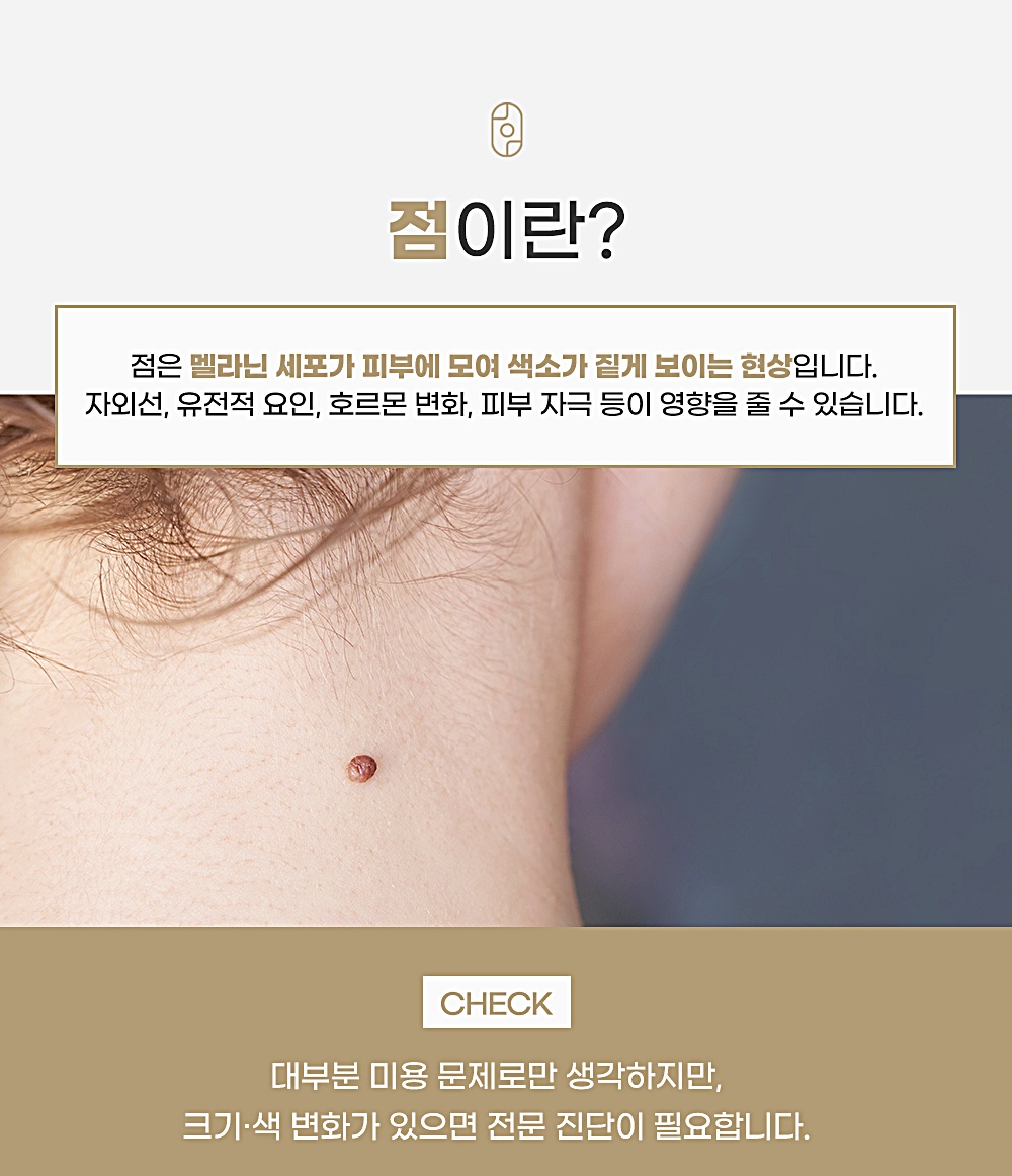 점이란? 멜라닌 세포가 피부에 모여 색소가 짙게 보이는 현상 설명