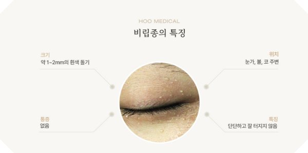 전주 비립종 특징 
