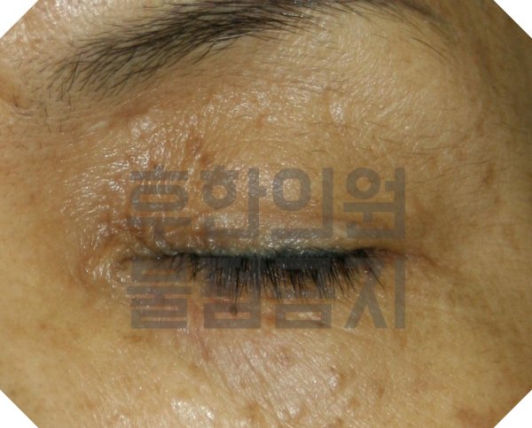 전주 비립종 한관종 치료 전