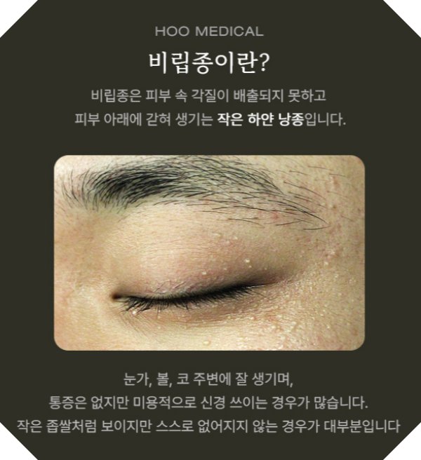 전주비립종 설명사진 