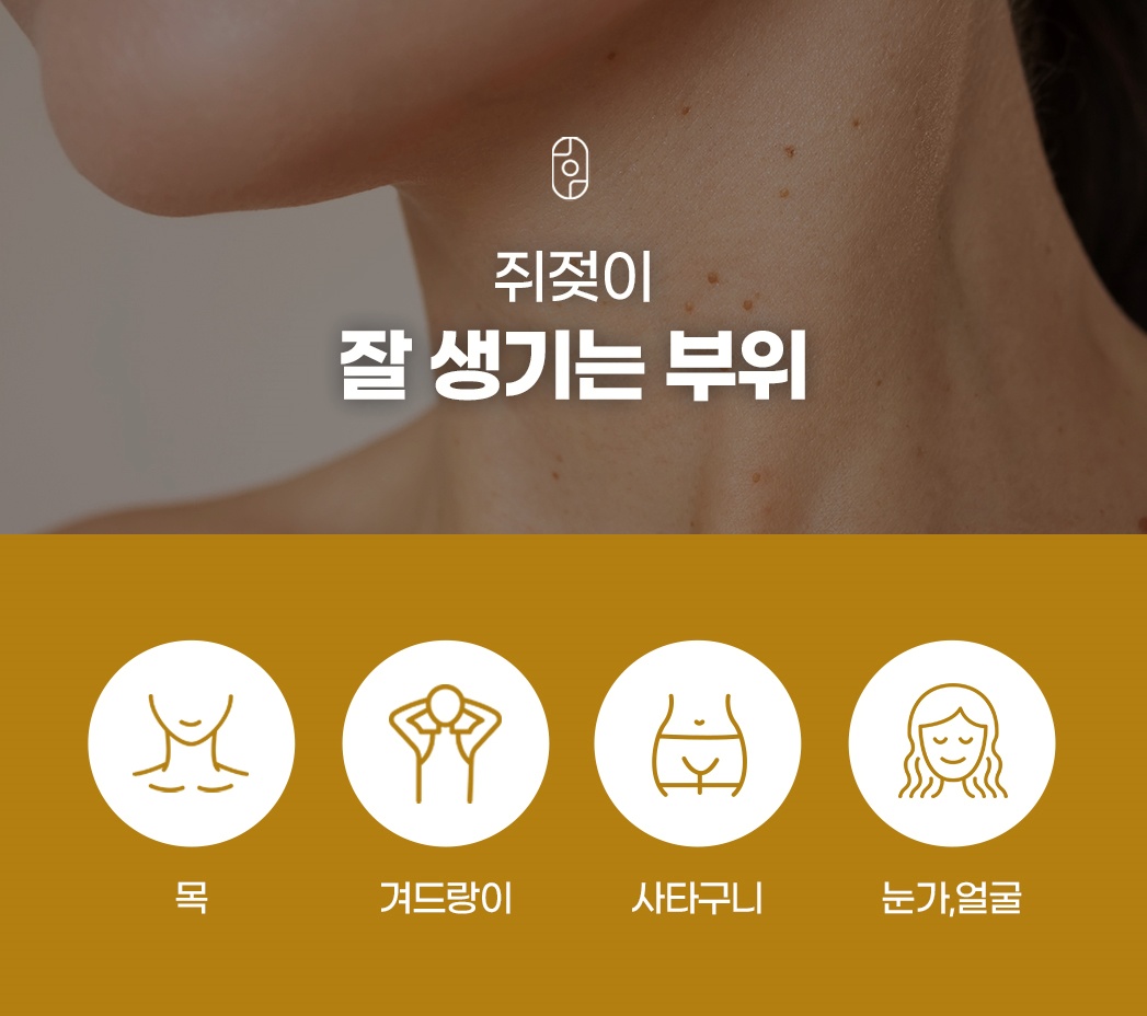 쥐젖 잘 생기는 부위
