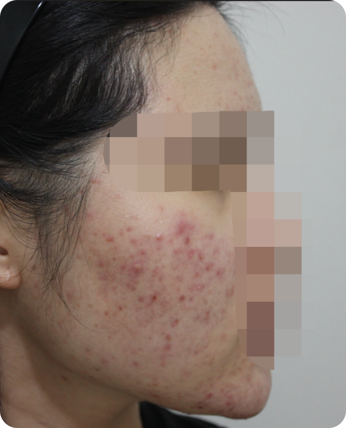 전주여드름 청소년여드름 케이스 1 치료 전 - 뺨과 턱 염증여드름 상태
