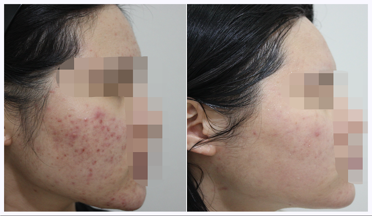전주여드름피부과 한의원 치료 전후