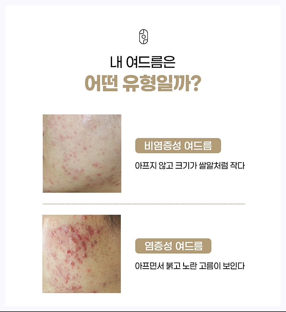 여드름의 유형을 설명하기 위한 이미지