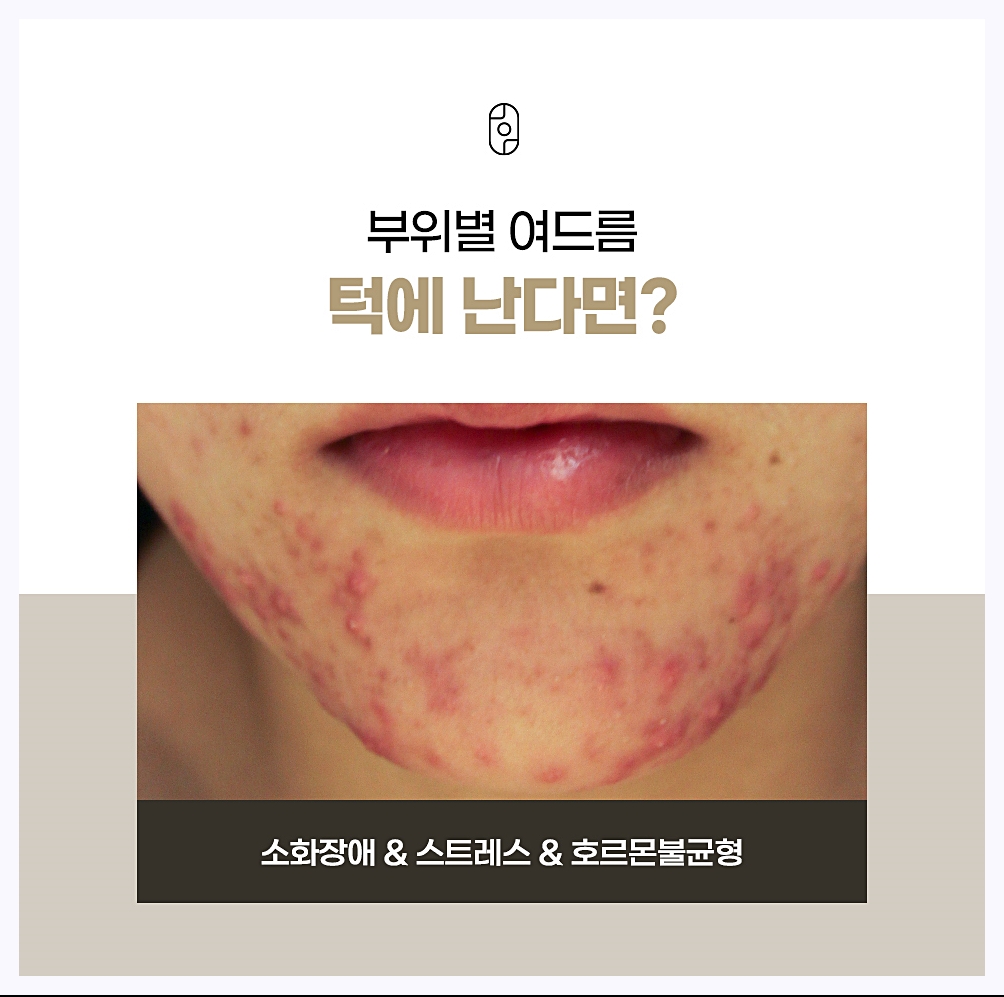 턱에 생기는 여드름의 원인