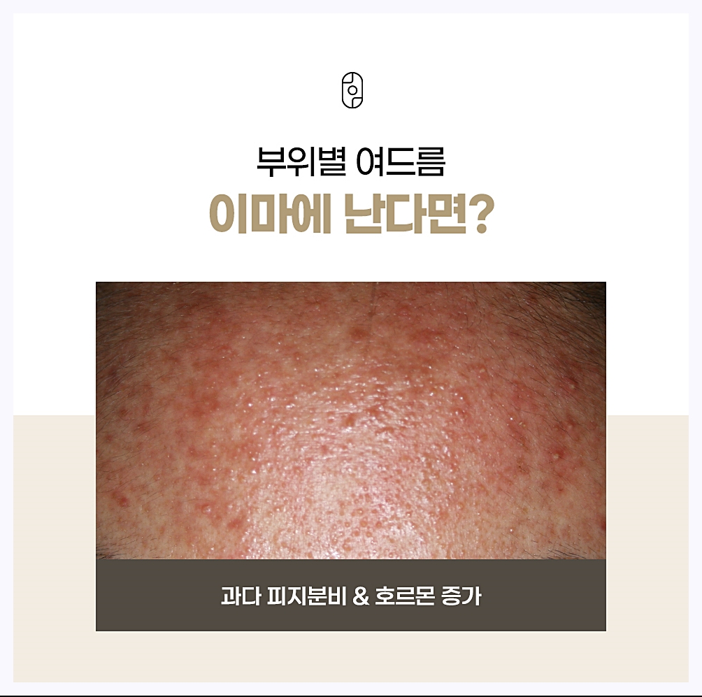 이마에 생기는 여드름의 원인