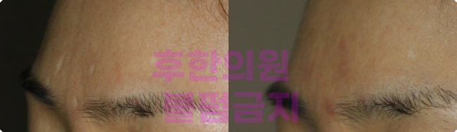 전주수두흉터 완치 후 최종 결과 - 자연스럽게 복원된 피부 표면