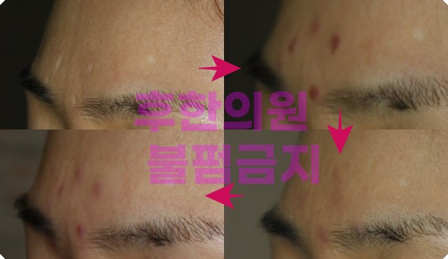 전주수두흉터 치료 경과 사진 - 좌측 시술 전 여러 개의 흉터, 우측 시술 후 개선된 상태