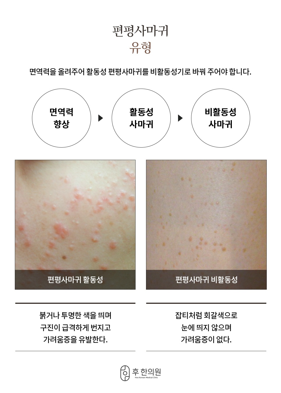 편평사마귀 유형 구별 활동성 및 비활동성 증상 특징