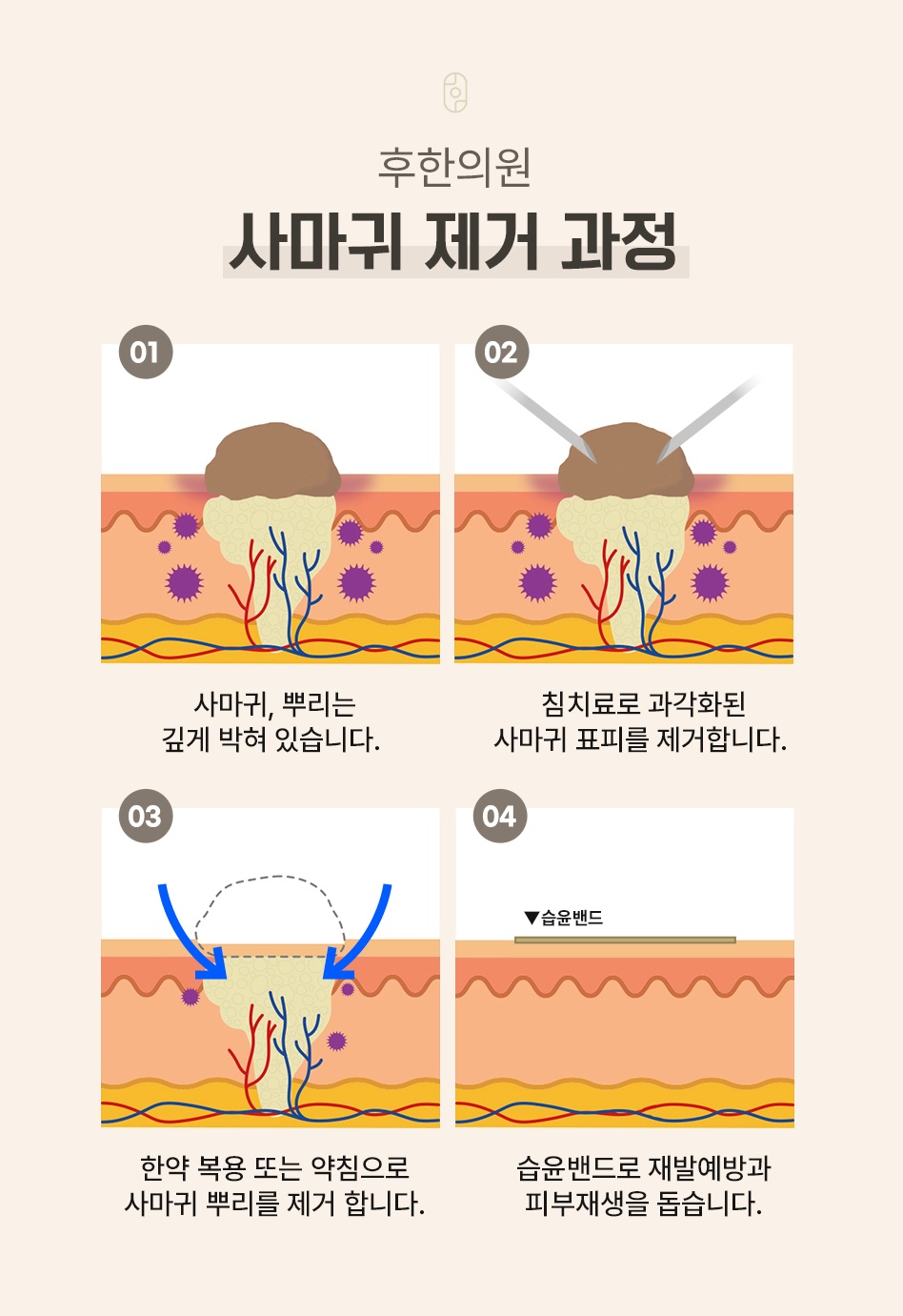 후한의원 사마귀 제거 과정 침치료 약침 습윤밴드 단계별 안내