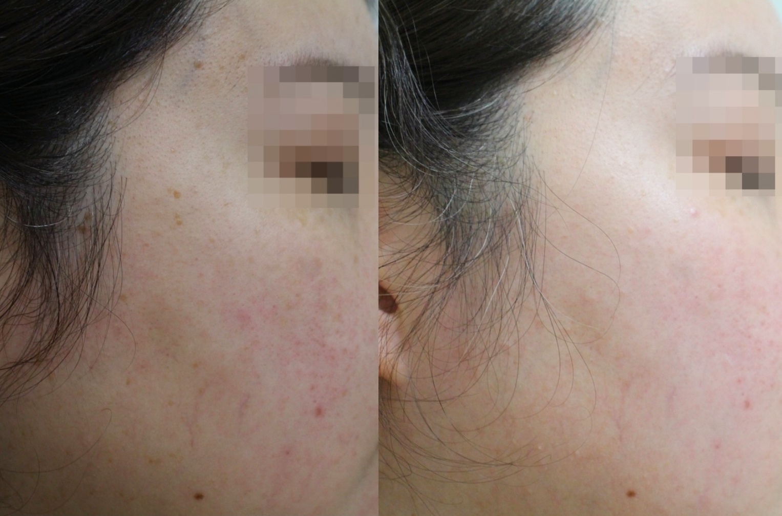 전주편평사마귀 치료 전후 볼 피부 상태 비교