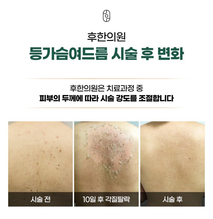 등여드름 필링 시술 후 3단계 변화 과정 - 시술 전, 10일 후 각질탈락, 최종 결과