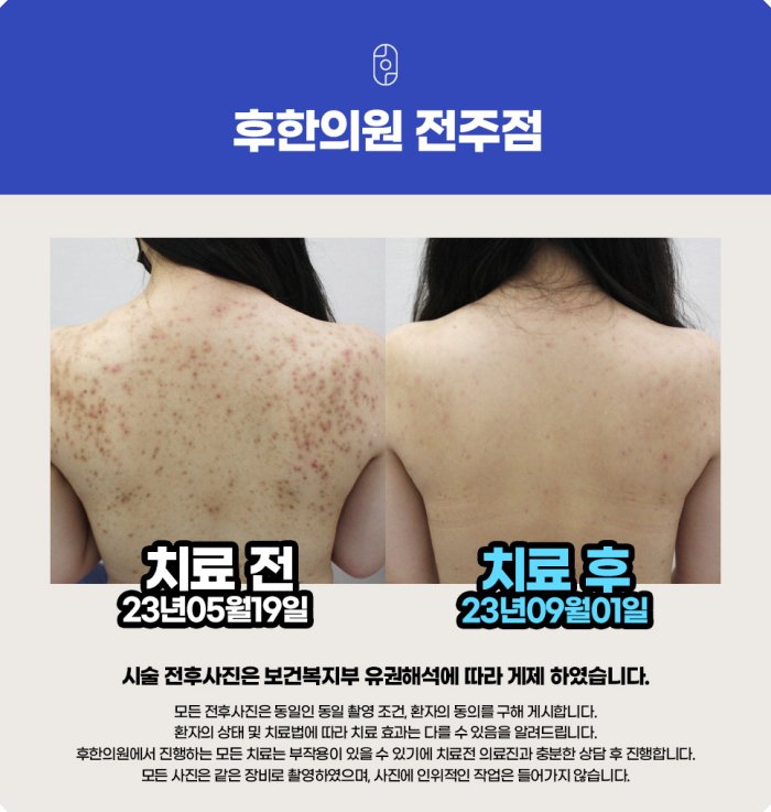 전주 등여드름 치료 전후 사진 - 2023년 5월 19일 시술 전, 9월 1일 치료 후 약 4개월 경과