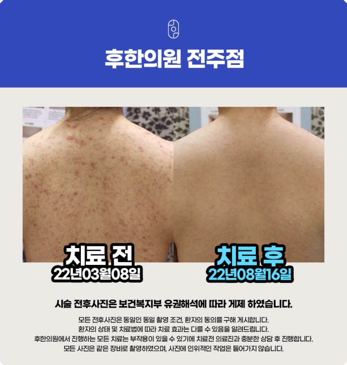 전주 등여드름 치료 전후 사진 - 2022년 3월 8일 시술 전, 8월 16일 치료 후 약 5개월 경과