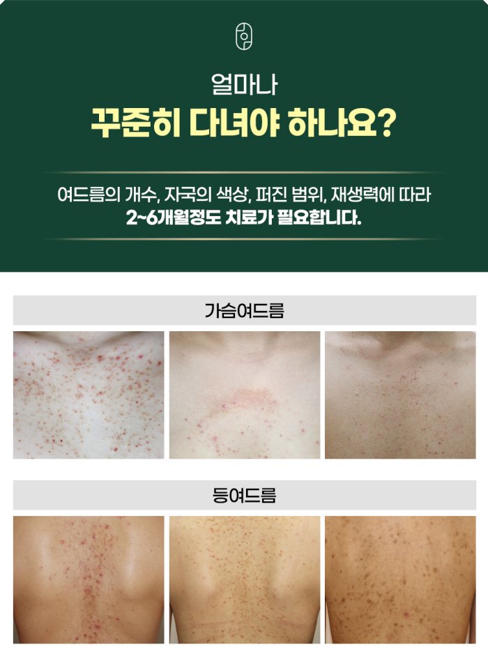 가슴여드름과 등여드름 회복 기간 비교 - 2~6개월 필요 기간 시각화
