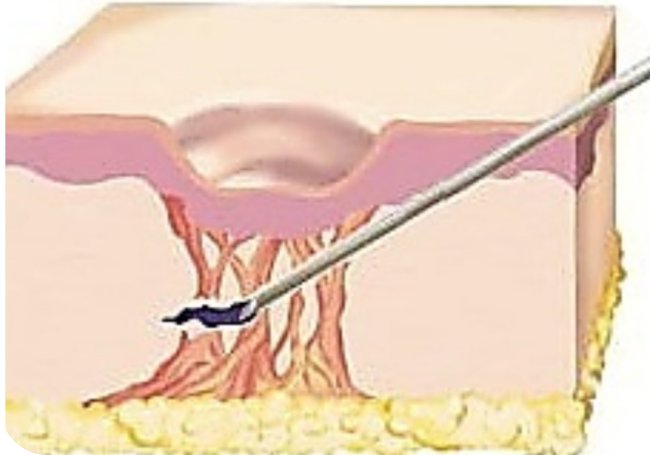 패인 흉터 바닥을 당기는 섬유성 밴드와 서브시전 원리 그림