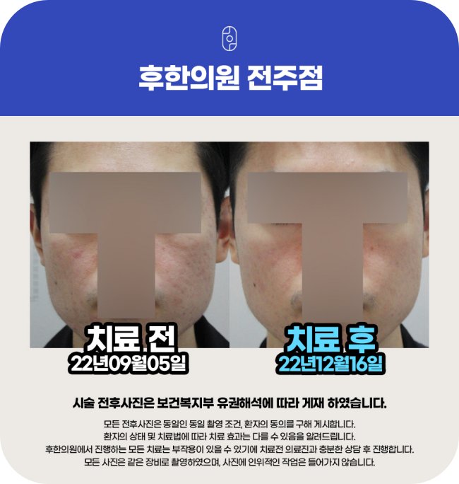 전주 후한의원 여드름흉터 치료 전후 비교 사진