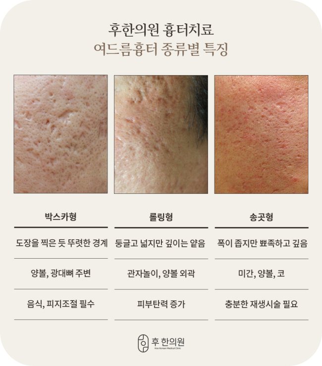 전주여드름흉터레이저 - 박스카형, 롤링형, 송곳형 여드름흉터 종류별 특징