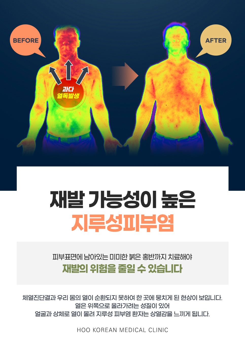 얼굴과 상체에 열이 몰린 모습을 보여주는 체열진단 촬영 전후 비교