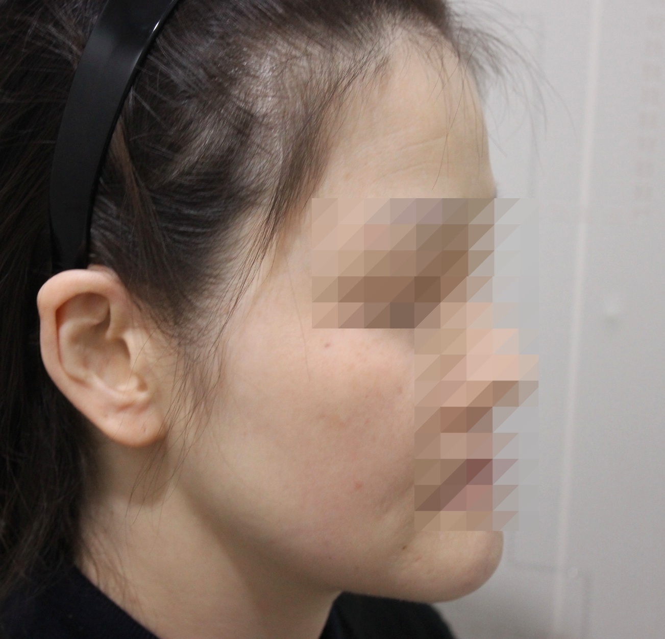 붉은기가 가라앉은 뺨 옆모습 치료 후 사진