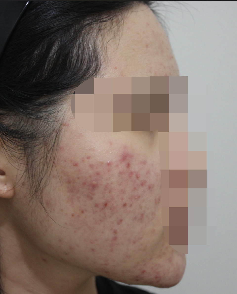 전주여드름한의원 치료 전 사진 - 볼과 턱선에 퍼진 염증성 여드름