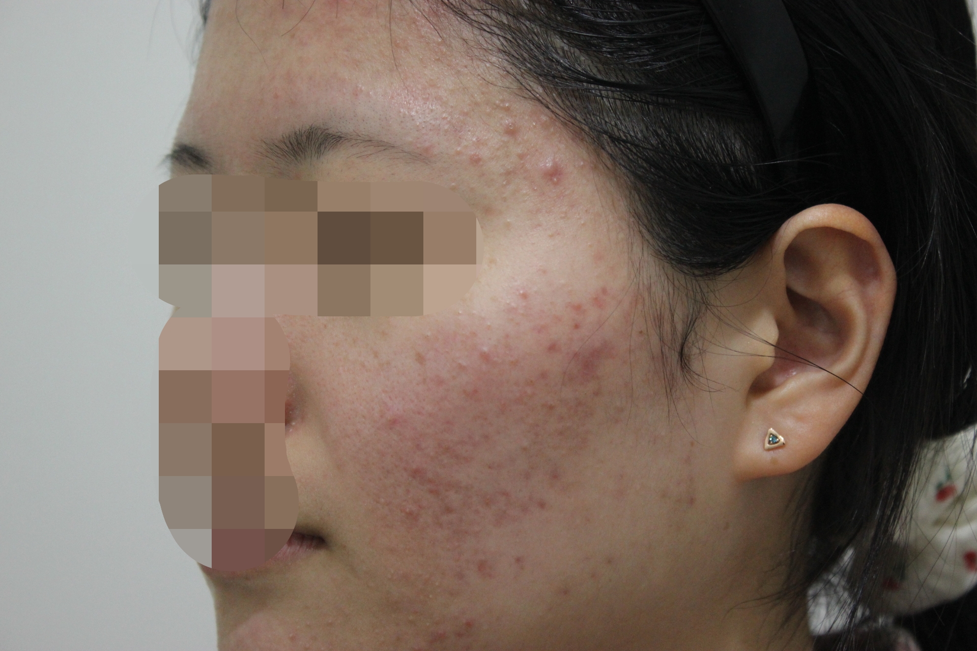 전주여드름한의원 치료 전 사진 - 붉은기와 좁쌀이 섞인 볼 여드름