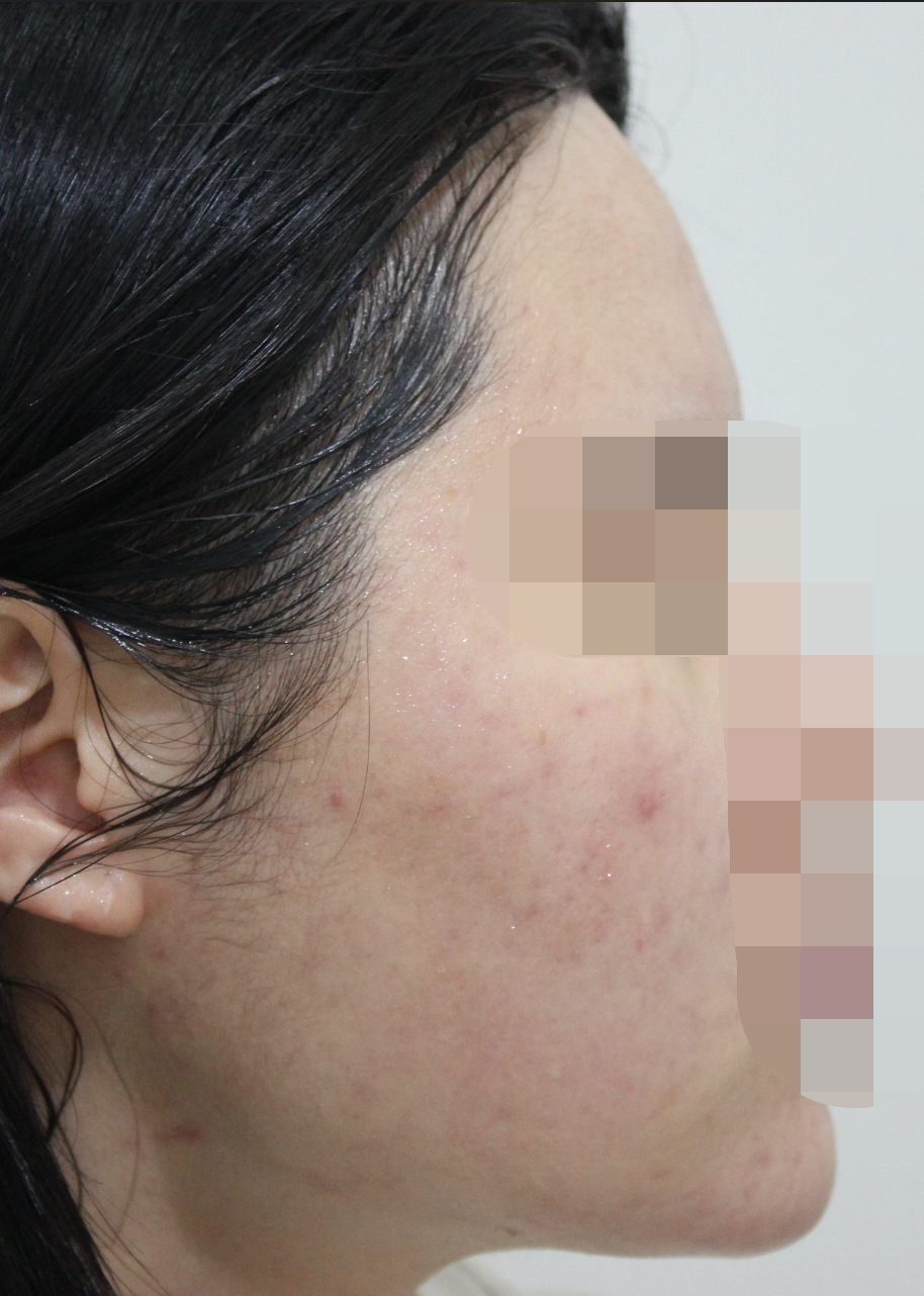 전주여드름한의원 치료 후 사진 - 볼과 턱선 염증성 여드름 개선