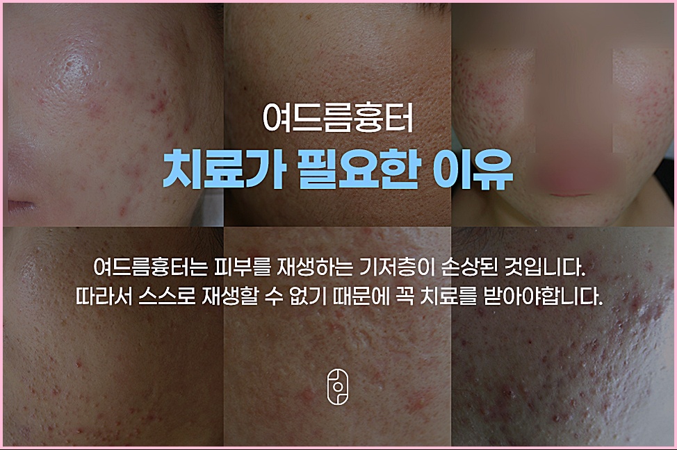 전주여드름흉터가 스스로 회복되지 않는 이유를 설명