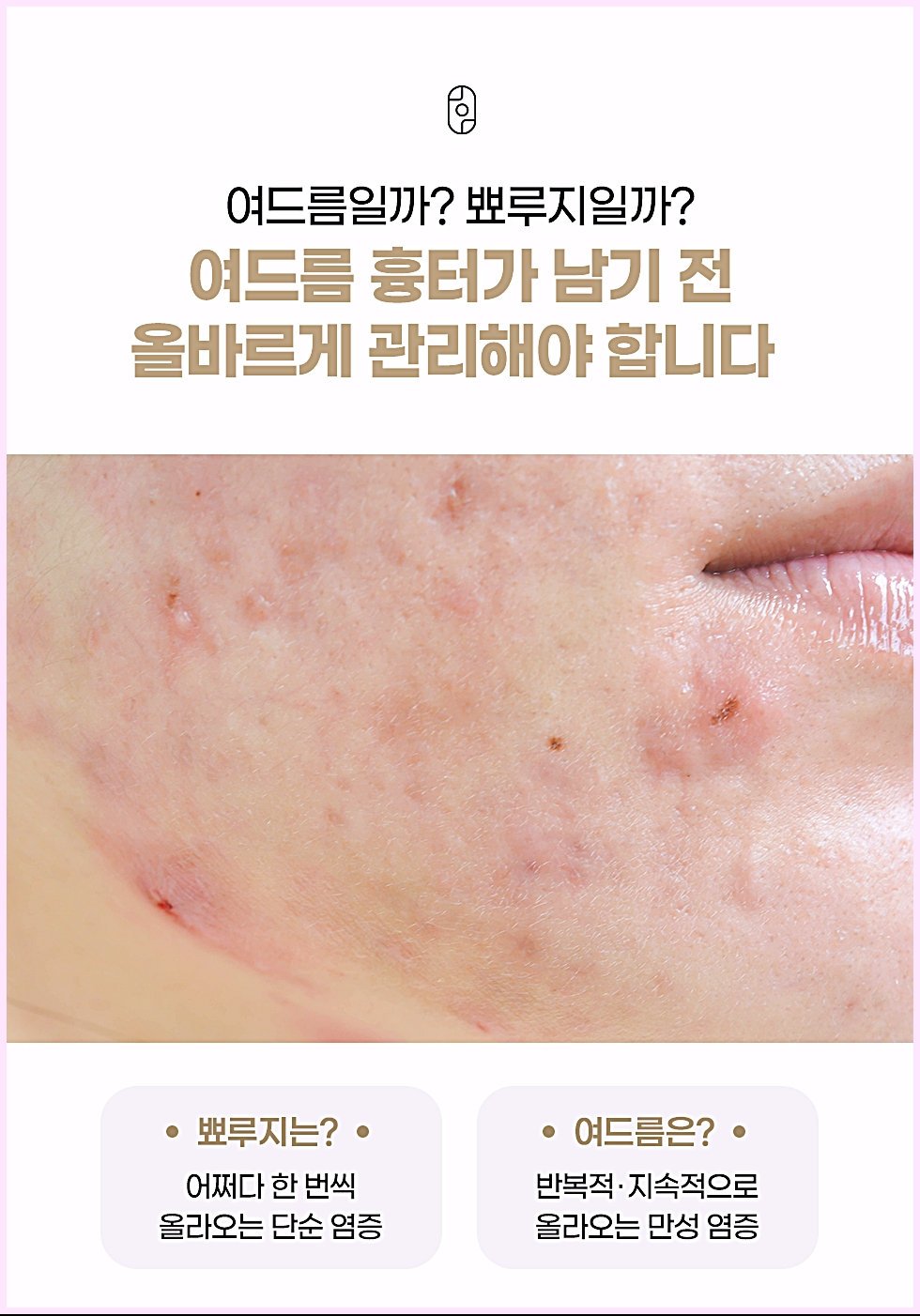 여드름과 뾰루지 차이를 설명하는 얼굴 볼 부위 여드름 자국 이미지
