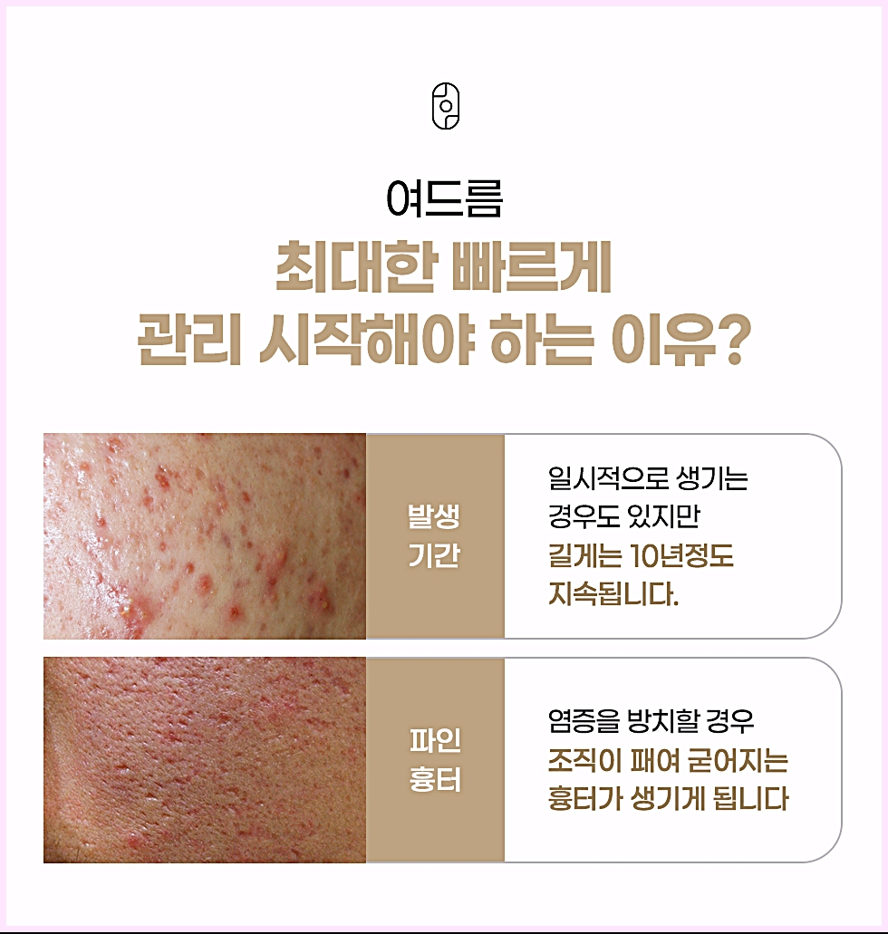 전주여드름치료 시 알아야 할 여드름 발생 기간 정리