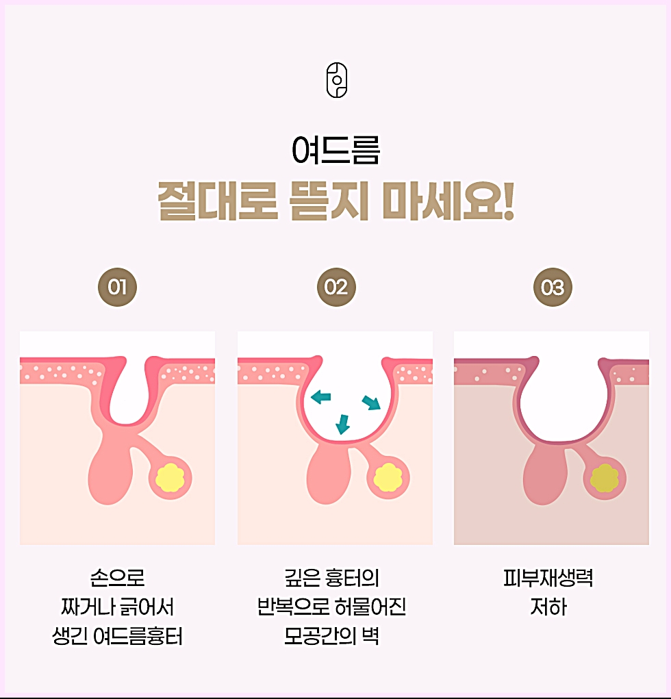 손으로 짜거나 긁어서 생긴 여드름 흉터와 모공 벽 변화를 보여주는 단계별 도식
