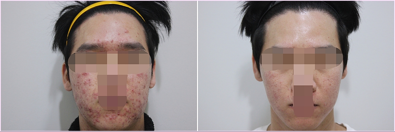 전주여드름치료 3개월 전후 비교 사진, 얼굴 전반의 붉은 염증성 여드름 변화