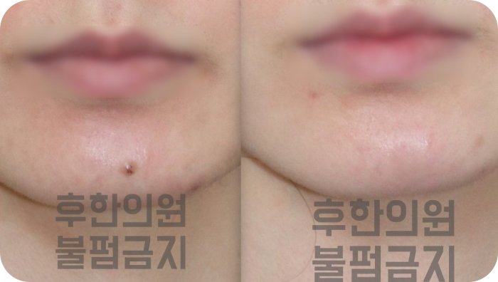 전주 얼굴 돌출점 제거  턱 주변 병변 전후