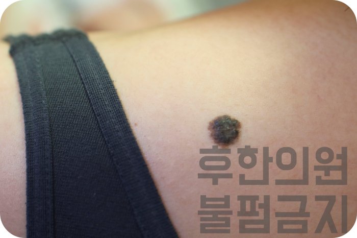 전주돌출점 제거 전 피부 위로 튀어나온 돌출점