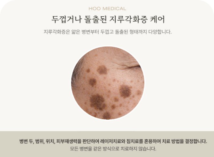 얼굴에 여러 개 퍼진 두껍고 돌출된 검버섯, 전주검버섯 제거 케어 안내