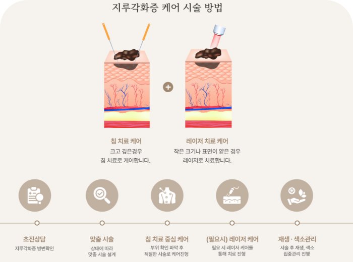 지루각화증 침치료와 레이저 치료 비교 그림 및 시술 5단계 과정
