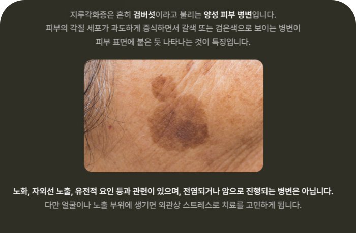  관자놀이에 생긴 갈색 지루각화증(검버섯) 병변 사진, 양성 피부 병변 설명