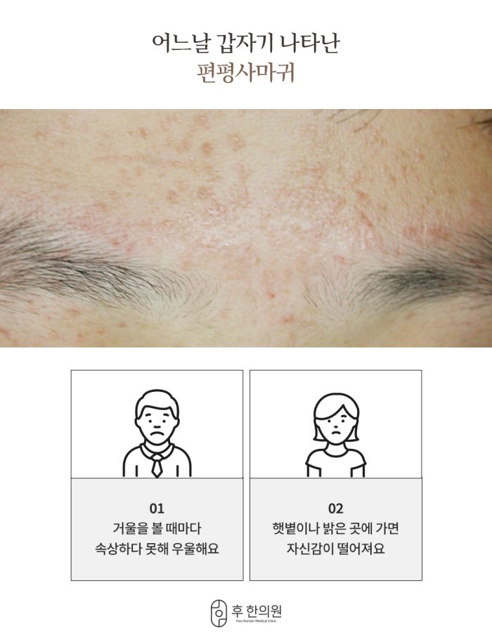 편평사마귀 증상 
