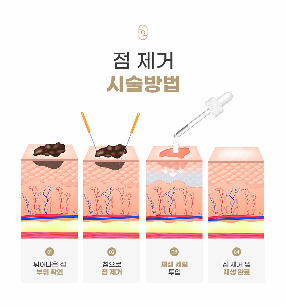 점 부위 확인, 침 제거, 재생세럼 투입, 재생 완료로 이어지는 점제거 4단계 과정