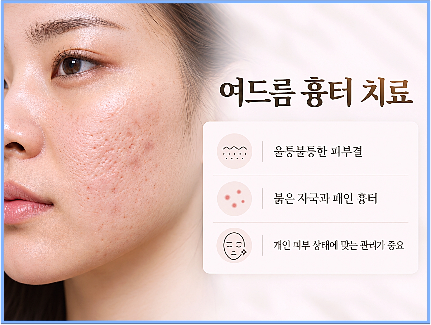 전주여드름흉터 치료 안내, 울퉁불퉁한 피부결과 붉은 자국