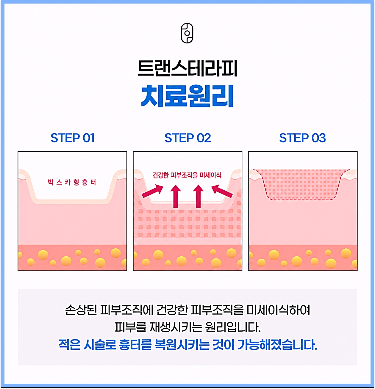 트랜스테라피 치료원리 3단계, 박스카형 흉터에 건강한 피부조직을 미세이식하는 도식