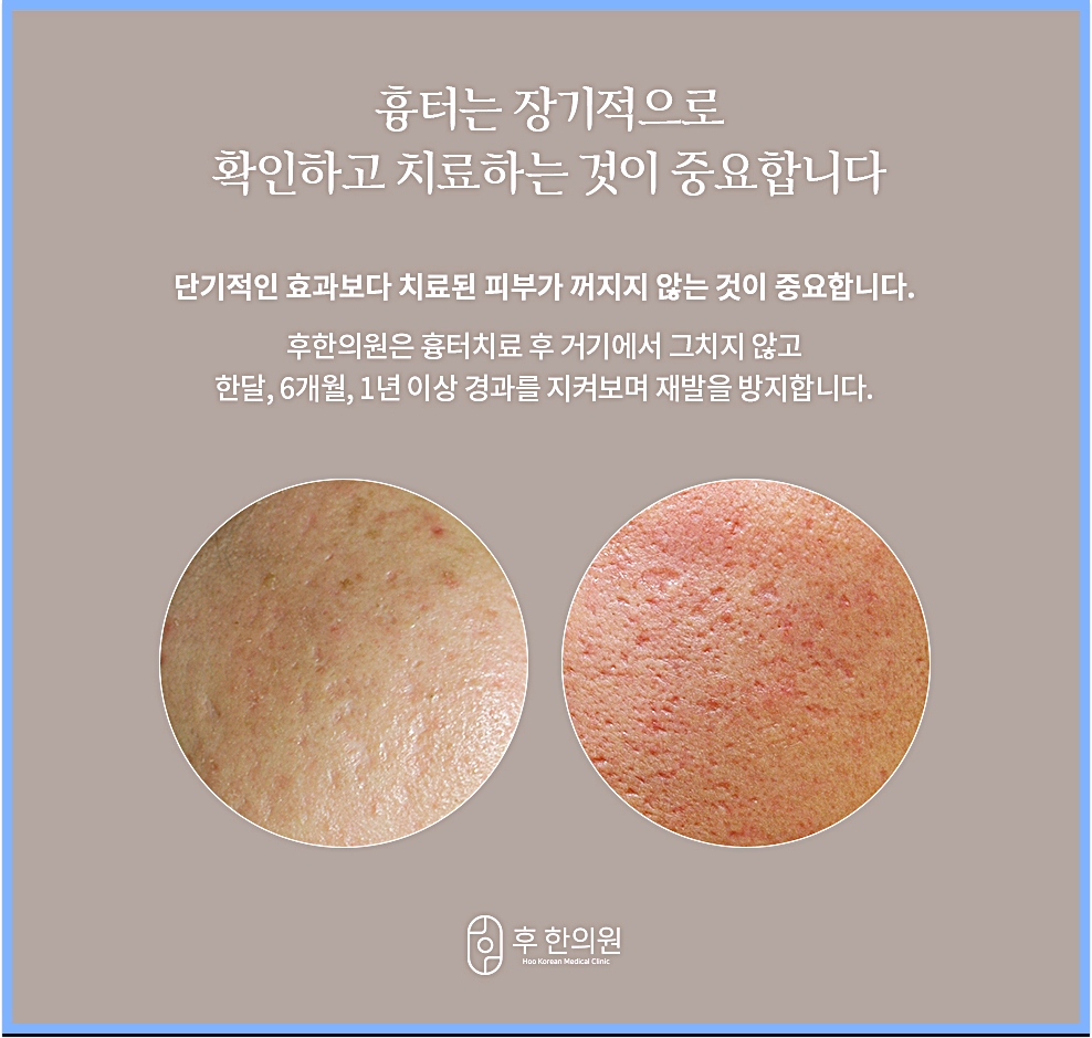 흉터는 장기적으로 확인하고 치료해야 한다는 후한의원 경과 관찰 안내
