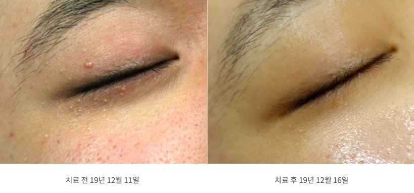 비립종 눈 부위 치료 전후