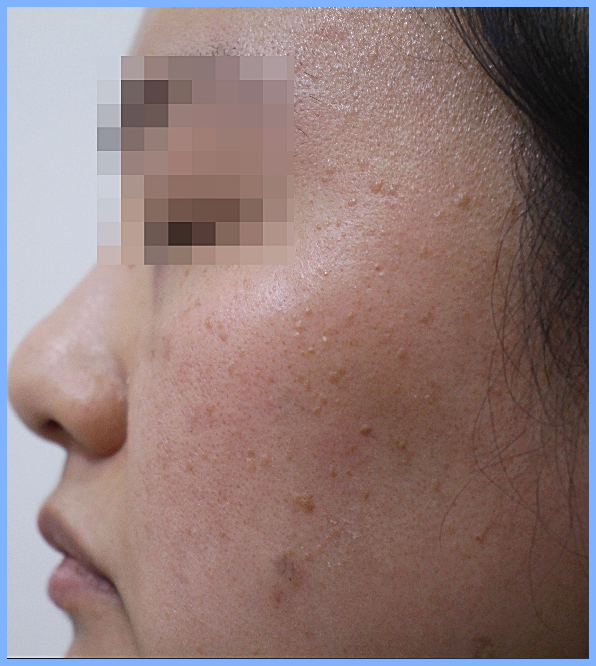 후한의원 전주점 사율침 편평사마귀 제거술 치료 전 볼 부위